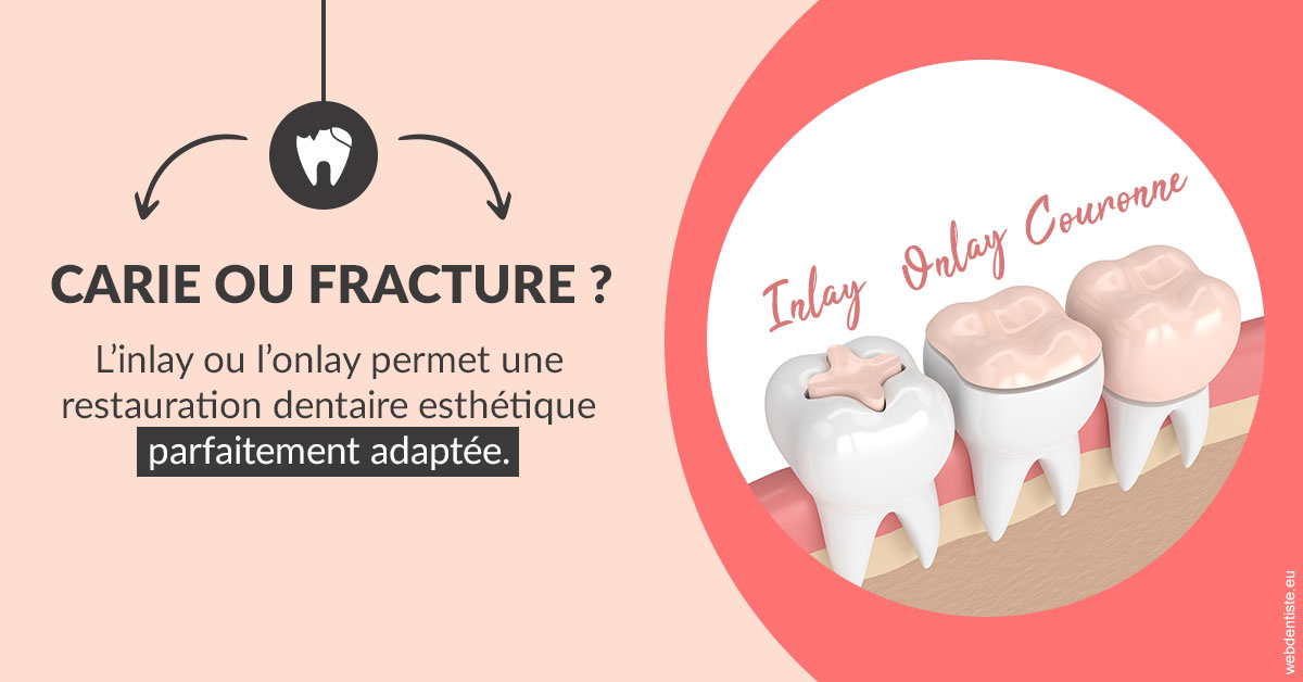 https://dr-naim-valerie.chirurgiens-dentistes.fr/T2 2023 - Carie ou fracture 2