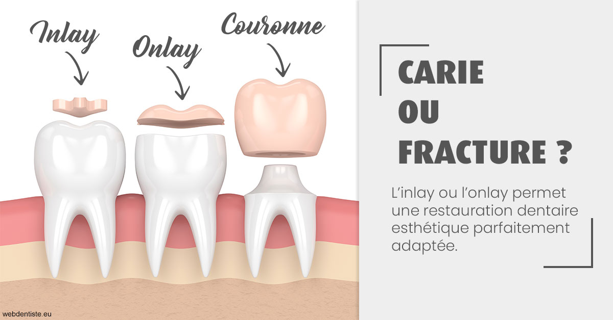 https://dr-naim-valerie.chirurgiens-dentistes.fr/T2 2023 - Carie ou fracture 1