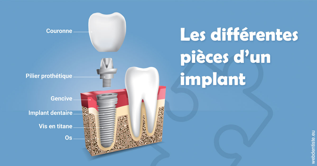https://dr-naim-valerie.chirurgiens-dentistes.fr/Les différentes pièces d’un implant 1